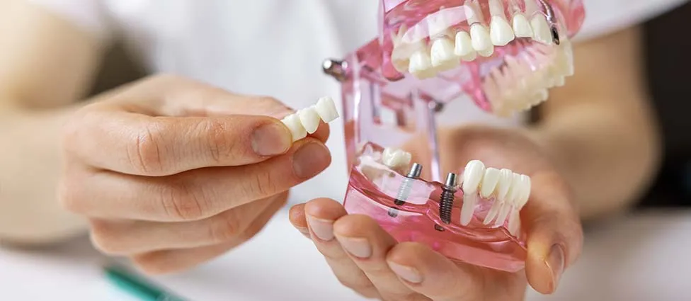 Dental implant model